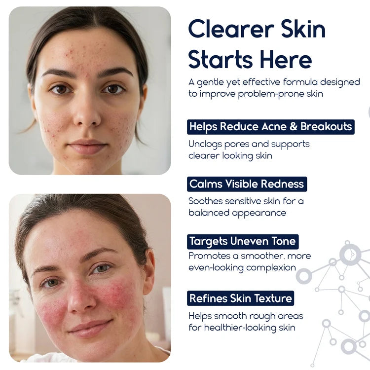 Azelaic Acid 15% Cream – Acne Control, Redness Relief & Tone Correction | 30ml