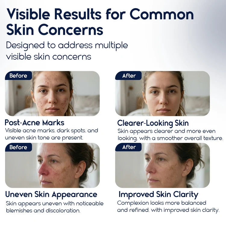 Azelaic Acid 15% Cream – Acne Control, Redness Relief & Tone Correction | 30ml